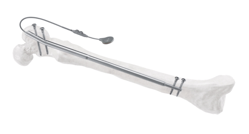 Orthofix Rolls Out Fitbone Trochanteric Lengthening System in U.S.